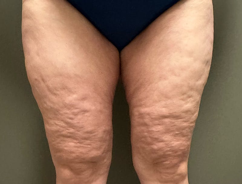 Thigh Lift Before & After Gallery - Patient 286157 - Image 1
