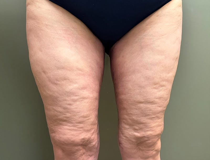 Thigh Lift Before & After Gallery - Patient 286157 - Image 2