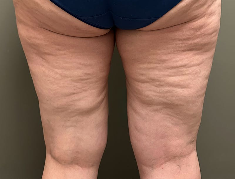 Thigh Lift Before & After Gallery - Patient 286157 - Image 3