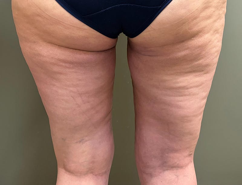 Thigh Lift Before & After Gallery - Patient 286157 - Image 4