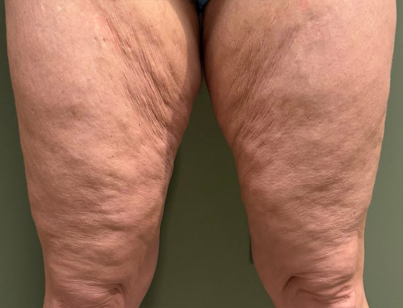 Thigh Lift Before & After Gallery - Patient 199580 - Image 1