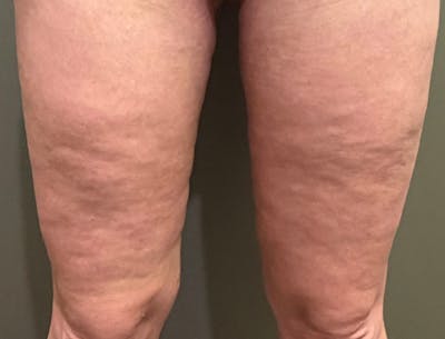 Thigh Lift Before & After Gallery - Patient 199580 - Image 2