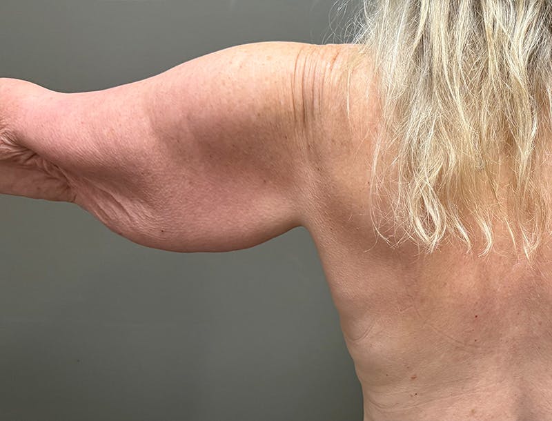 Brachioplasty-Arm Lift Before & After Gallery - Patient 366508 - Image 1