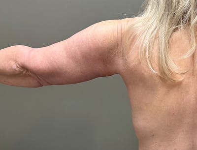 Brachioplasty-Arm Lift Before & After Gallery - Patient 366508 - Image 2