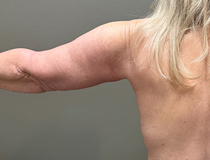 Brachioplasty-Arm Lift Before & After Gallery - Patient 366508 - Image 2