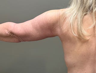 Brachioplasty-Arm Lift Before & After Gallery - Patient 366508 - Image 2
