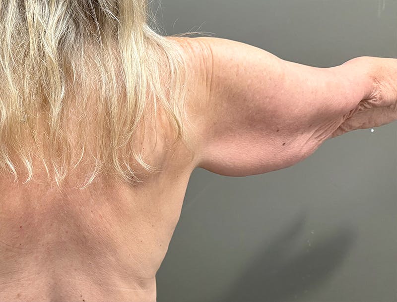 Brachioplasty-Arm Lift Before & After Gallery - Patient 366508 - Image 7