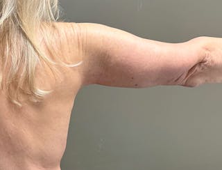 Brachioplasty-Arm Lift Before & After Gallery - Patient 366508 - Image 8