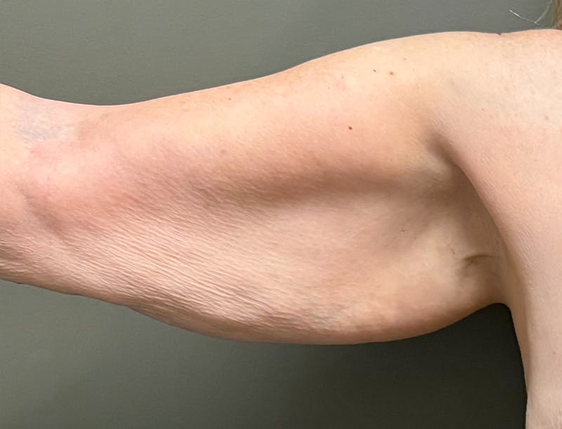 Brachioplasty-Arm Lift Before & After Gallery - Patient 366508 - Image 5
