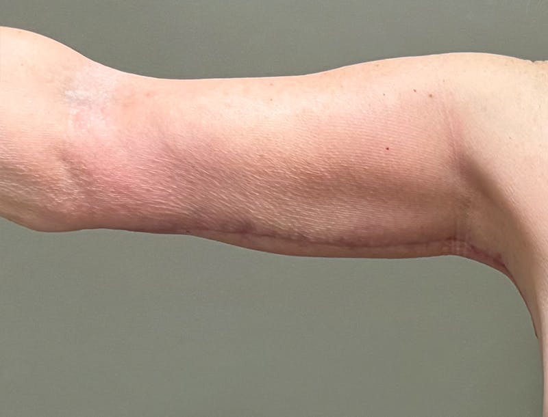 Brachioplasty-Arm Lift Before & After Gallery - Patient 366508 - Image 6