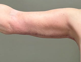 Brachioplasty-Arm Lift Before & After Gallery - Patient 366508 - Image 6