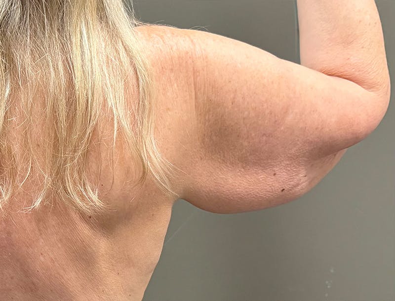 Brachioplasty-Arm Lift Before & After Gallery - Patient 366508 - Image 9