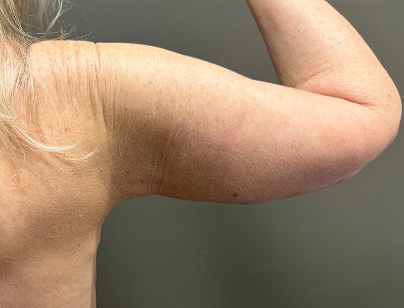 Brachioplasty-Arm Lift Before & After Gallery - Patient 366508 - Image 10