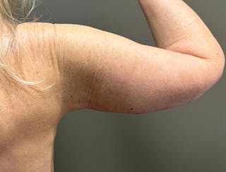 Brachioplasty-Arm Lift Before & After Gallery - Patient 366508 - Image 10