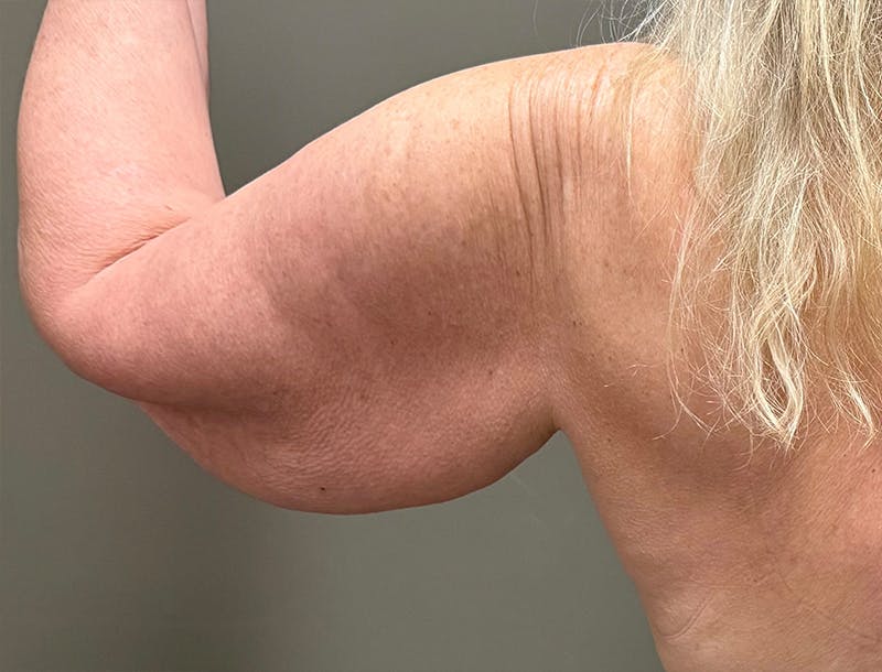 Brachioplasty-Arm Lift Before & After Gallery - Patient 366508 - Image 3