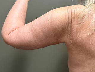 Brachioplasty-Arm Lift Before & After Gallery - Patient 366508 - Image 4