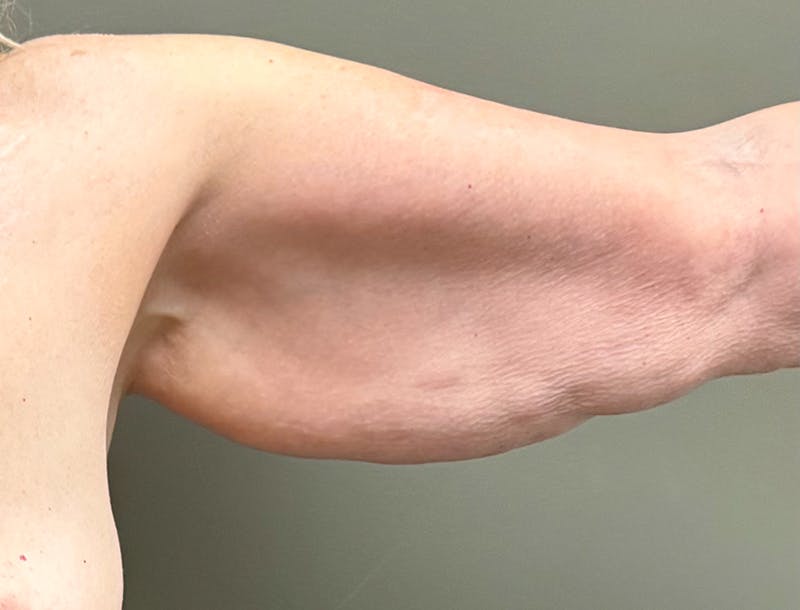 Brachioplasty-Arm Lift Before & After Gallery - Patient 366508 - Image 11