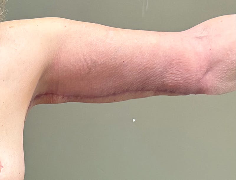 Brachioplasty-Arm Lift Before & After Gallery - Patient 366508 - Image 12