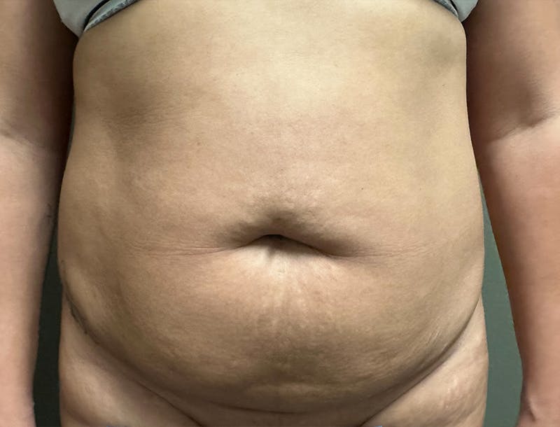 Abdominoplasty and Body Contouring Before & After Gallery - Patient 977255 - Image 1