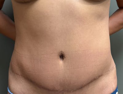 Abdominoplasty and Body Contouring Before & After Gallery - Patient 977255 - Image 2
