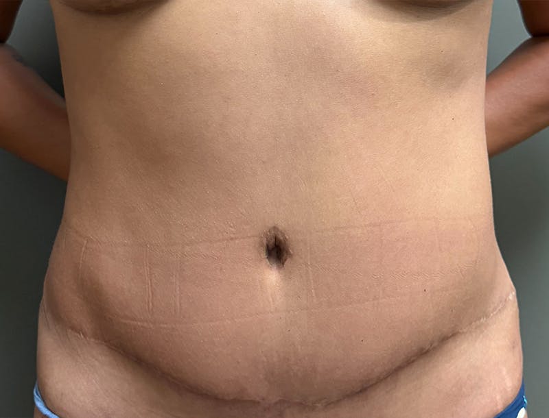 Abdominoplasty and Body Contouring Before & After Gallery - Patient 977255 - Image 2