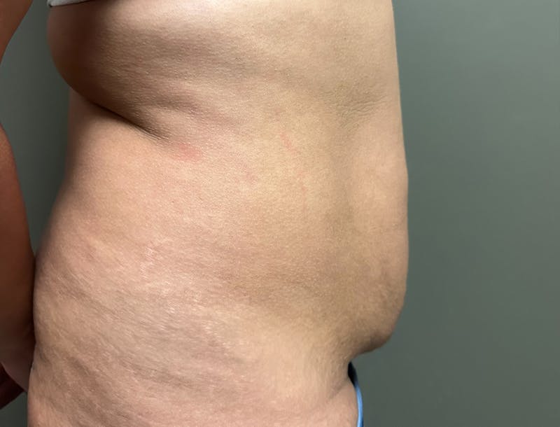 Abdominoplasty and Body Contouring Before & After Gallery - Patient 977255 - Image 5