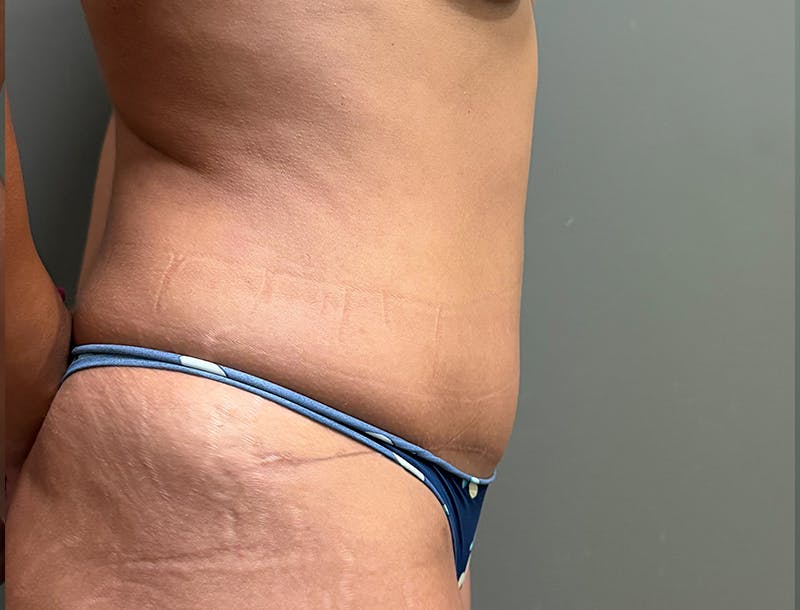 Abdominoplasty and Body Contouring Before & After Gallery - Patient 977255 - Image 6