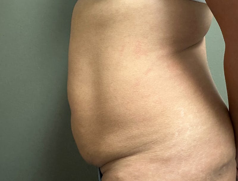 Abdominoplasty and Body Contouring Before & After Gallery - Patient 977255 - Image 3