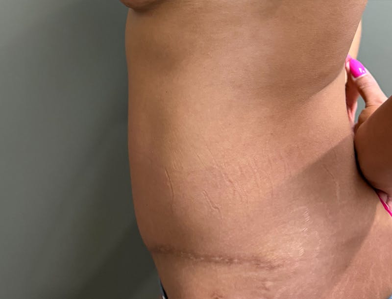 Abdominoplasty and Body Contouring Before & After Gallery - Patient 977255 - Image 4