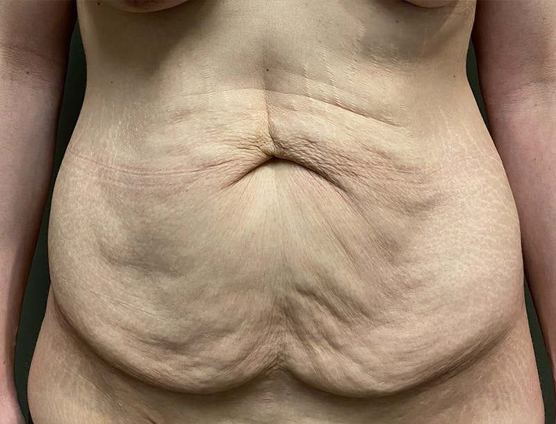 Abdominoplasty and Body Contouring Before & After Gallery - Patient 189907 - Image 1