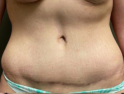 Abdominoplasty and Body Contouring Before & After Gallery - Patient 189907 - Image 2