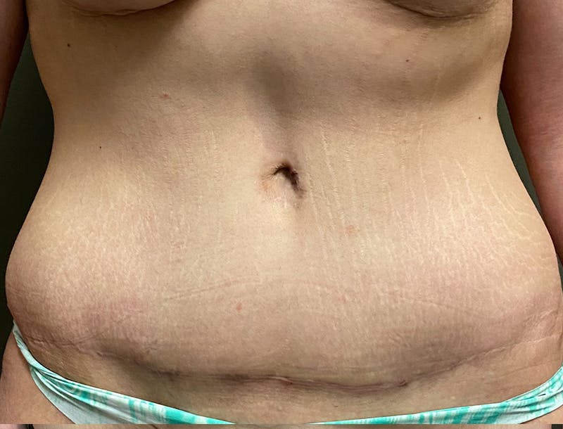Abdominoplasty and Body Contouring Before & After Gallery - Patient 189907 - Image 2