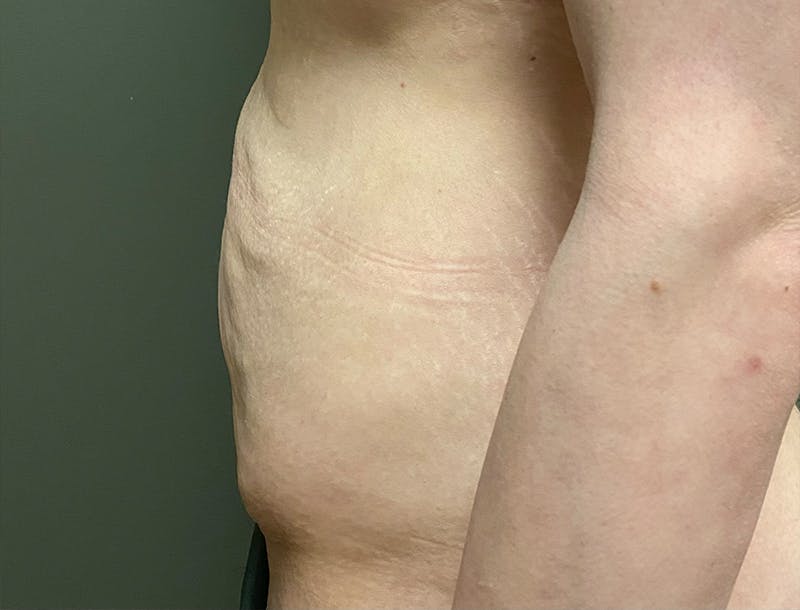 Abdominoplasty and Body Contouring Before & After Gallery - Patient 189907 - Image 3