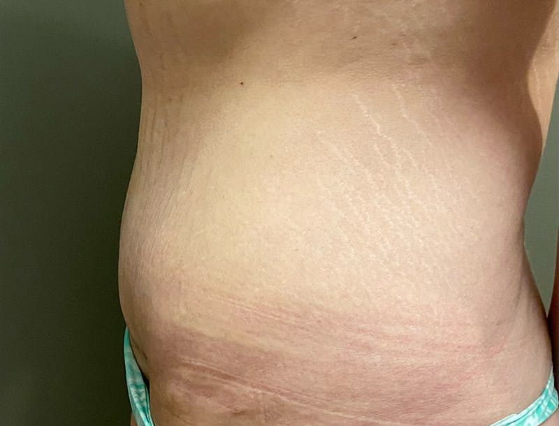 Abdominoplasty and Body Contouring Before & After Gallery - Patient 189907 - Image 4
