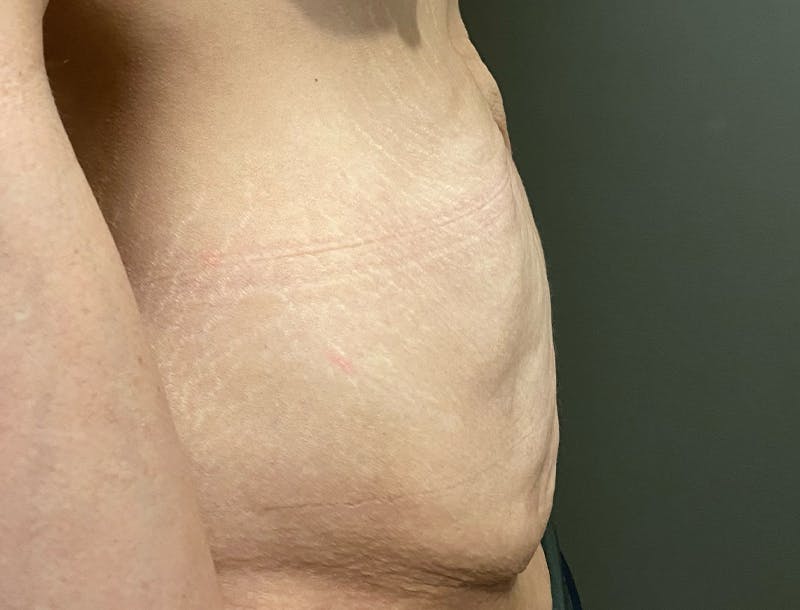 Abdominoplasty and Body Contouring Before & After Gallery - Patient 189907 - Image 5
