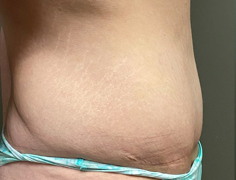 Abdominoplasty and Body Contouring Before & After Gallery - Patient 189907 - Image 6