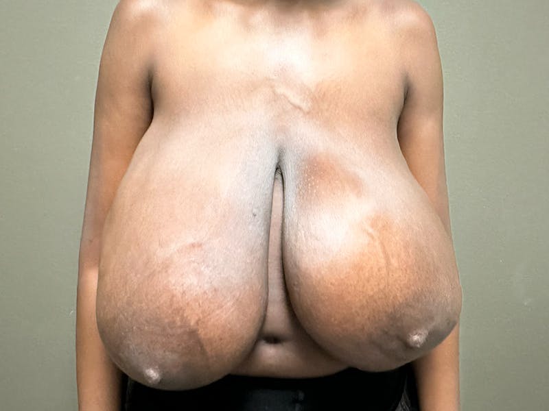 Breast Reduction and Lift Before & After Gallery - Patient 350341 - Image 1