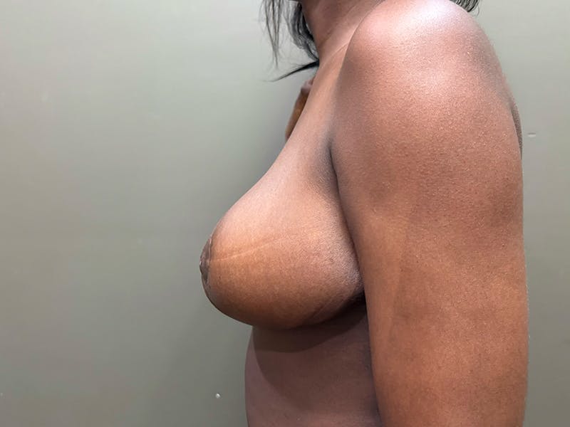 Breast Reduction and Lift Before & After Gallery - Patient 350341 - Image 4