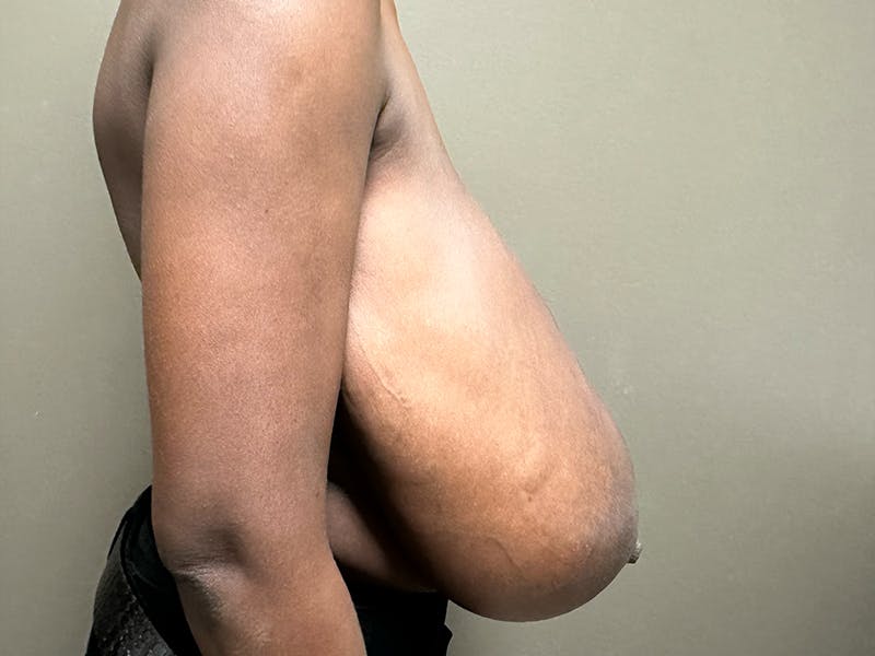 Breast Reduction and Lift Before & After Gallery - Patient 350341 - Image 5