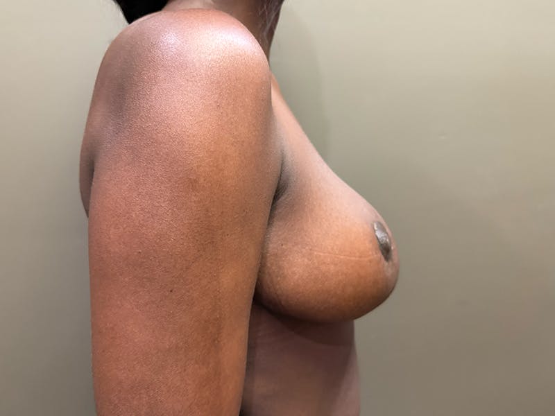 Breast Reduction and Lift Before & After Gallery - Patient 350341 - Image 6