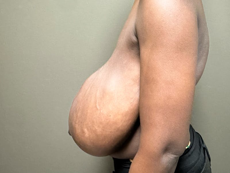Breast Reduction and Lift Before & After Gallery - Patient 350341 - Image 3