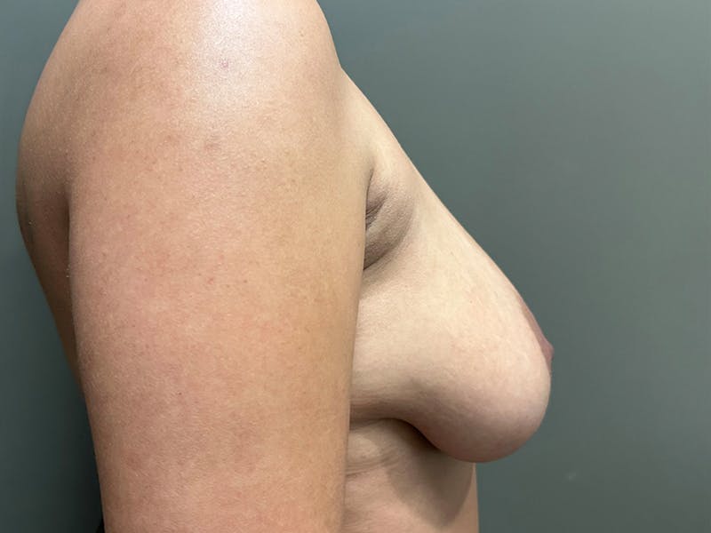 Breast Reduction and Lift Before & After Gallery - Patient 831129 - Image 5