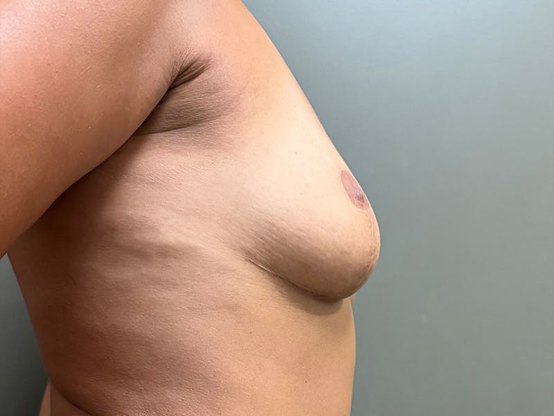 Breast Reduction and Lift Before & After Gallery - Patient 831129 - Image 6