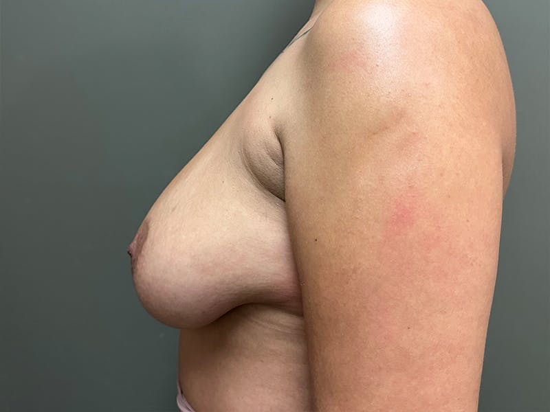 Breast Reduction and Lift Before & After Gallery - Patient 831129 - Image 3