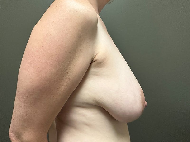 Breast Reduction and Lift Before & After Gallery - Patient 190448 - Image 5