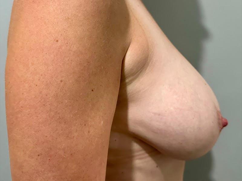 Breast Reduction and Lift Before & After Gallery - Patient 273837 - Image 5