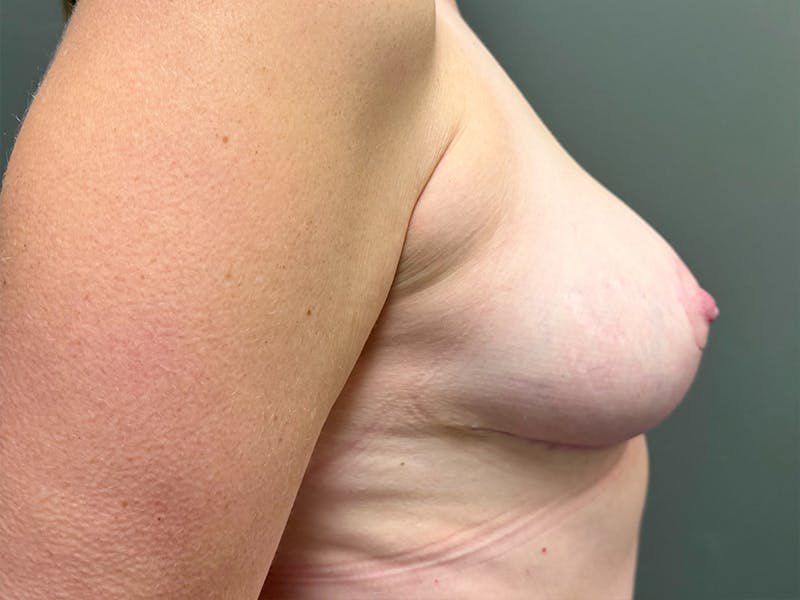 Breast Reduction and Lift Before & After Gallery - Patient 273837 - Image 6