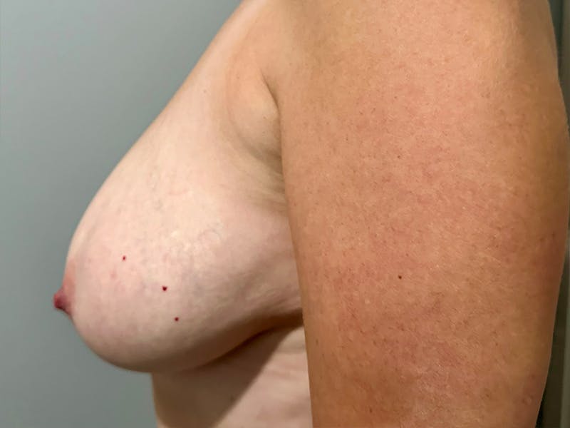 Breast Reduction and Lift Before & After Gallery - Patient 273837 - Image 3
