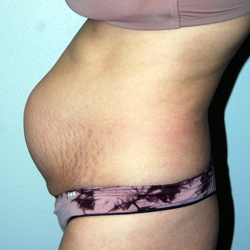 Abdominoplasty Before & After Gallery - Patient 420549 - Image 3