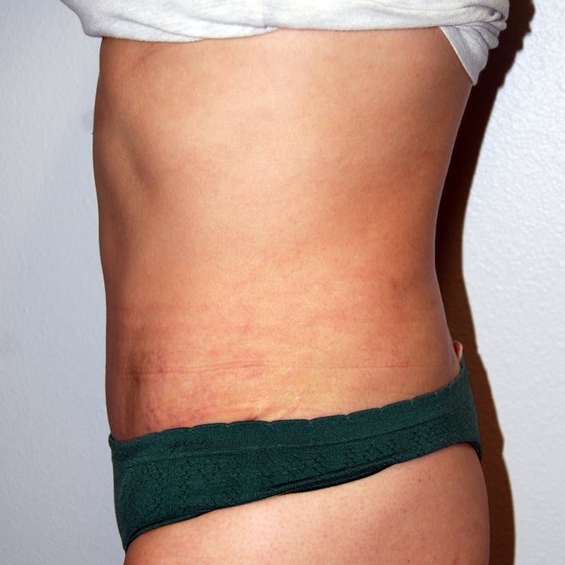 Abdominoplasty Before & After Gallery - Patient 420549 - Image 4